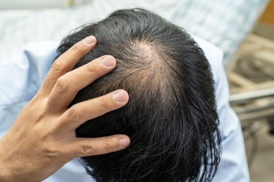 【為什麼會脫髮？了解男士脫髮的原因與治療方法】